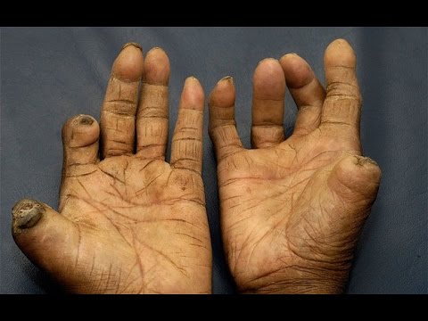 https://www.orthodox.net//photos/leprosy-hands.jpg